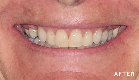 Dentistry After | Evers and Gardner Dental | Kansas City Northland Dentist