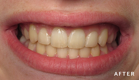 Dentistry After | Evers and Gardner Dental | 64154 Dentist