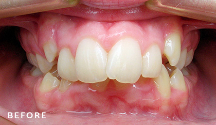 Dentistry Before | Evers and Gardner Dental | Kansas City Northland Dentist