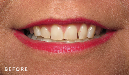 Dentistry Before | Evers and Gardner Dental | 64154 Dentist