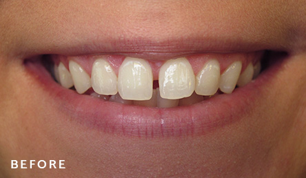 Dentistry Before | Evers and Gardner Dental | 64154 Dentist