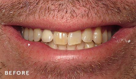 Dentistry Before | Evers and Gardner Dental | KC North Dentist