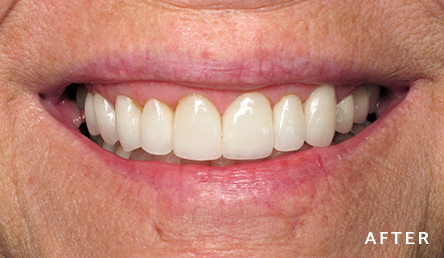 Dentistry After | Evers and Gardner Dental | KC North Dentist